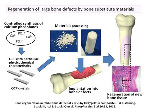 OSTEOCONDUCTIVE BIOCERAMICS: Eine Revolution im Bereich der Knochenregeneration?!